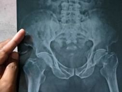 Support Balaram Manasingh Recover From Spinal Cord Disorders