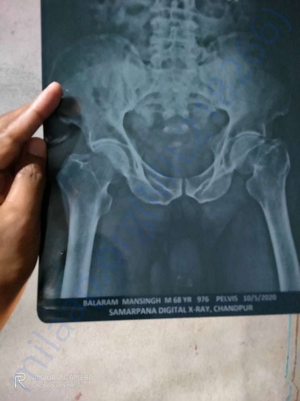 X ray