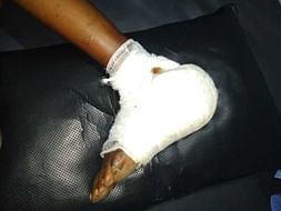 Sheikh Inayat - Left Foot Damaged due to Non Healing Ulcer