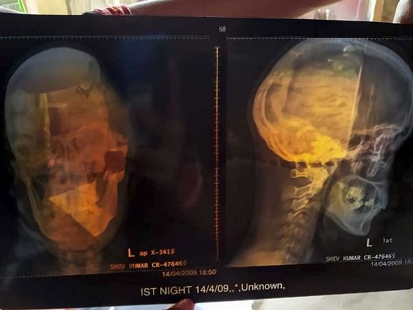 Support Shiv survive traumatic brain injury