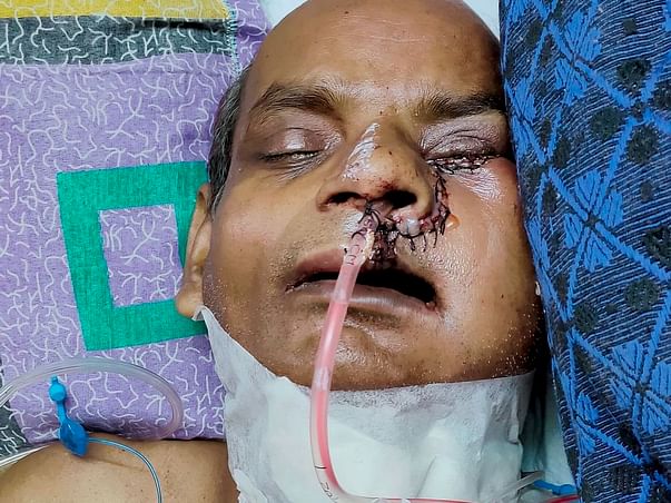 My uncle fight mouth cancer