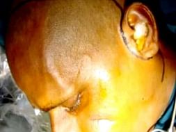 This 40 years old needs your urgent support in fighting Zygomaticomaxillary facture