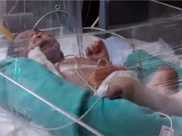 Support Baby of Satya Recover From Prematurely Born
