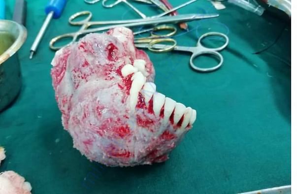 After Juvenile ossfying aggressive fibroma operation they removed jaw