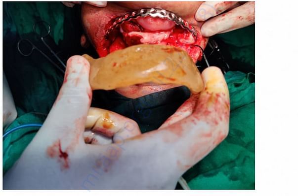 After removed jaw they replaced with plate to adjust the face structur
