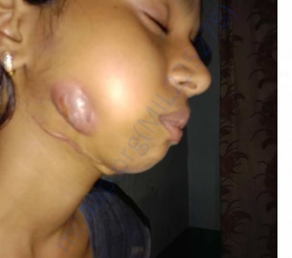 After placing the plate infection occurred due to infection pus form