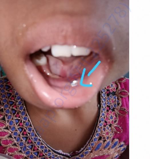 Due to infection plate exposed