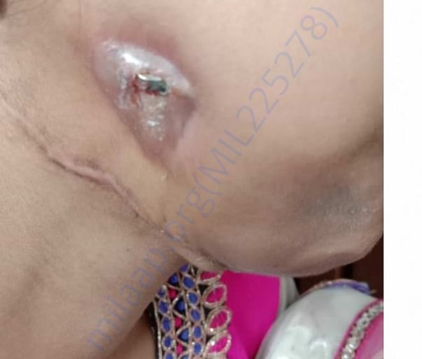 Due to infection plate exposer