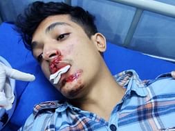 This 20 Years Old Needs Your Urgent Support In Fighting Road Traffic Accident With Face Injuries