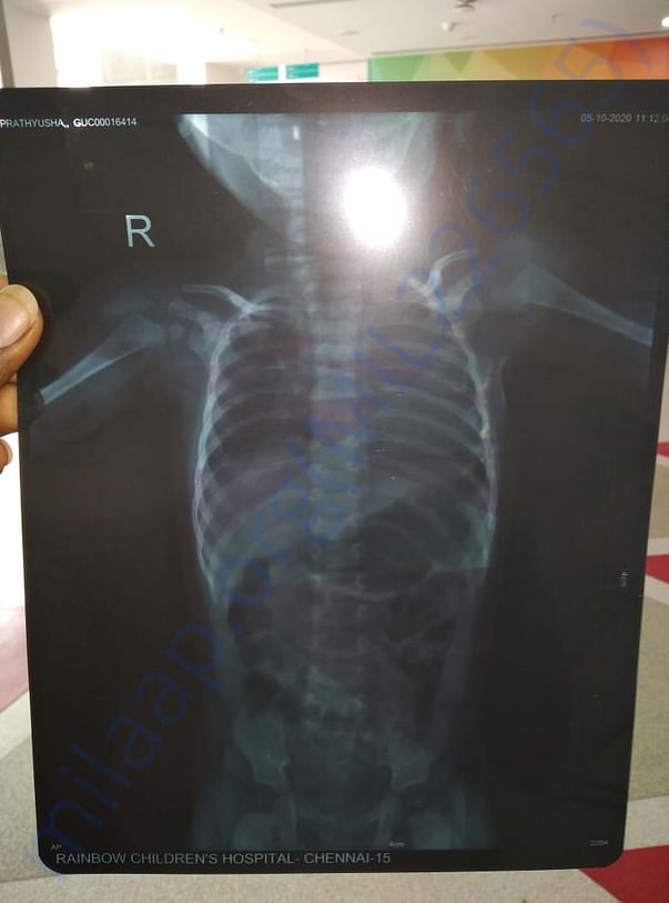 X RAY OF THE BABY