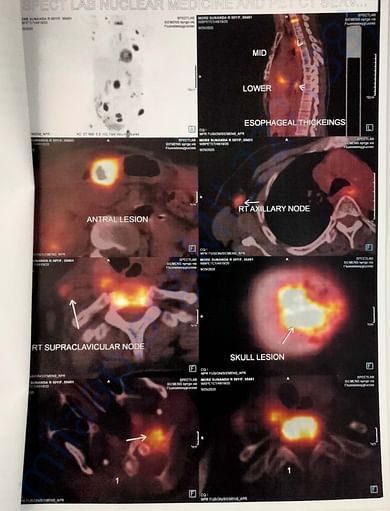 PET CT scan Showing cancerous Cells