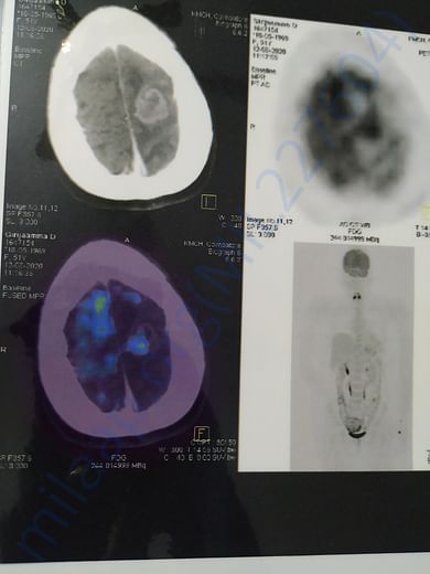 Initial PET scan report
