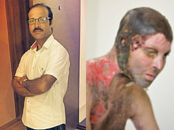 Support Uttam Naik Acid Attack Recovery