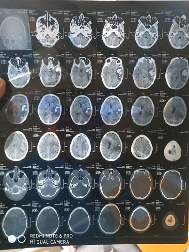 CT Brain