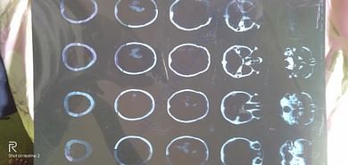Ct scan