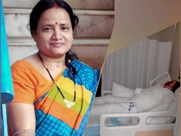Help My Mother Recover From Severe Burns