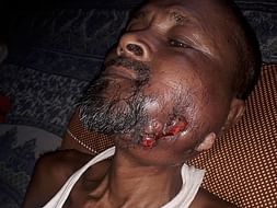 Support Fulruddin Mandal Recover From Oral Cancer
