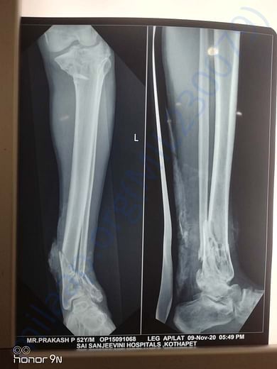 heel fracture