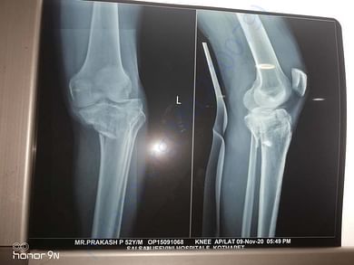 knee fracture 2
