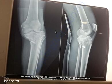 knee fracture