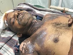 Help To A Person Name Satibabu Fight From Spinal Dysraphism