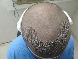 Help My Son Fight Alopecia