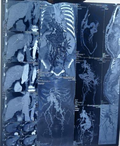 Liver tumors