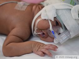 1.5 Months Old Baby Of Sunita Pal Needs Your Help Fight Neonatal ICU
