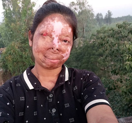 Anshu: Finding the lost identity after acid attack
