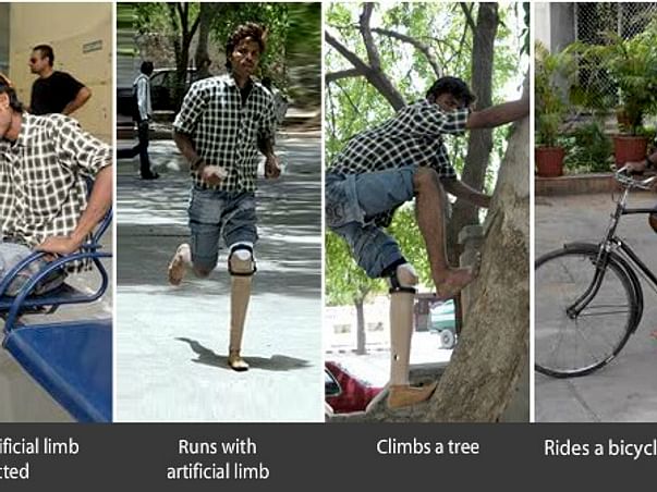 Fundraising to help Jaipur foot provide artificial limbs to 200 amputees. Support my project!