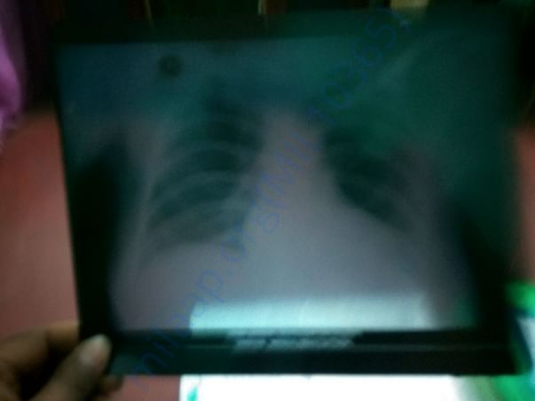 Heart scan xray report came negative heart is not so good