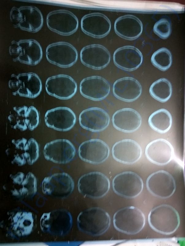 CT scan of brain after brain strok