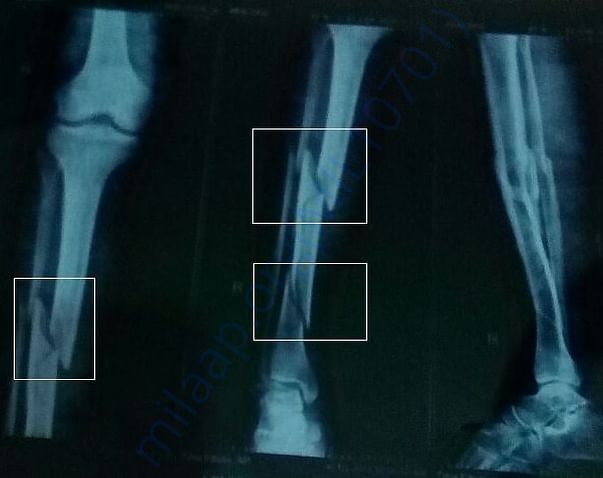 X-ray of the fractures
