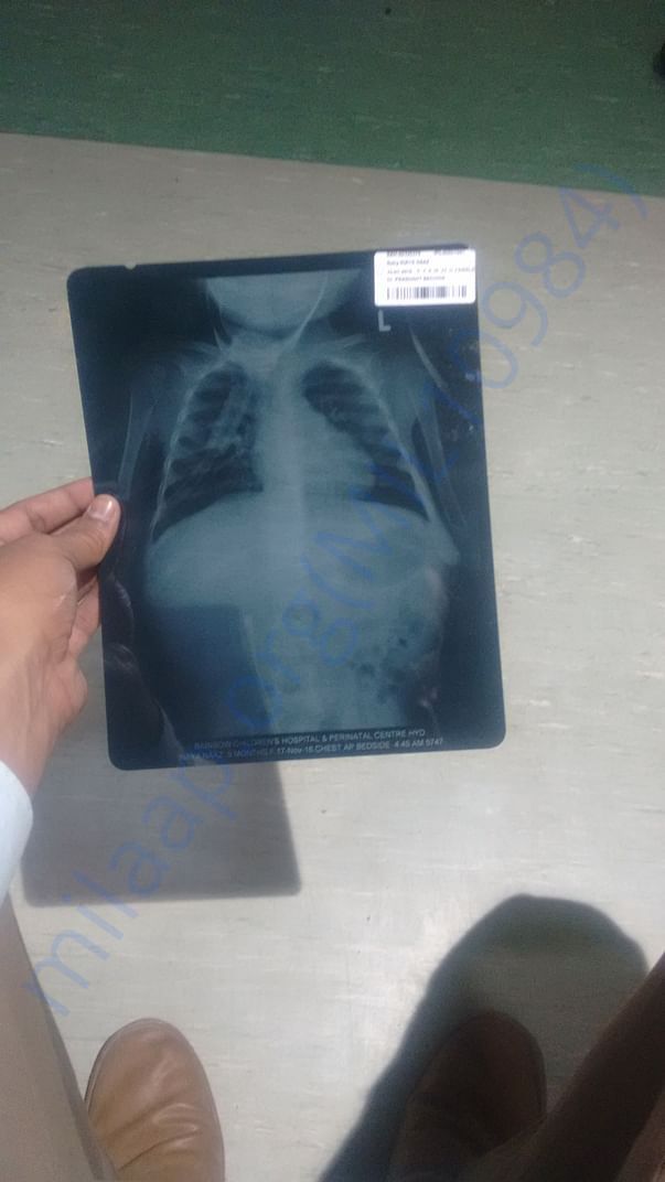 Lung Xray