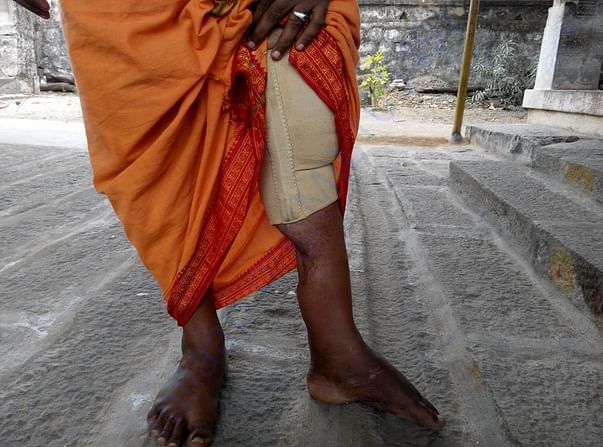 fractured leg
