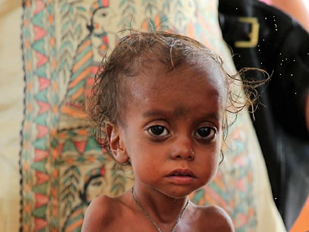You can save the lives of 40 malnourished children