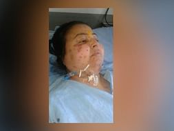 Save My Daughter Neeta From An Aggravating Lupus Disease
