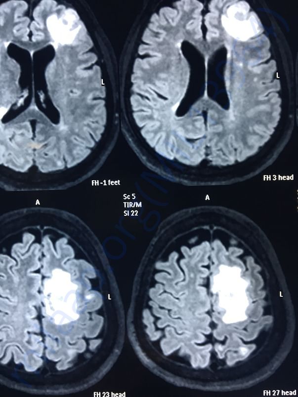 MRI REPORT