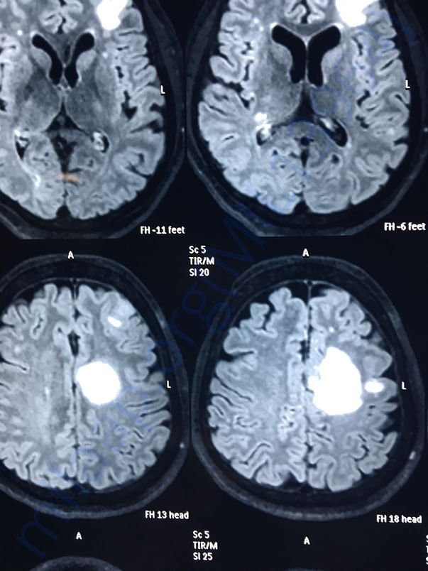 MRI REPORT 1