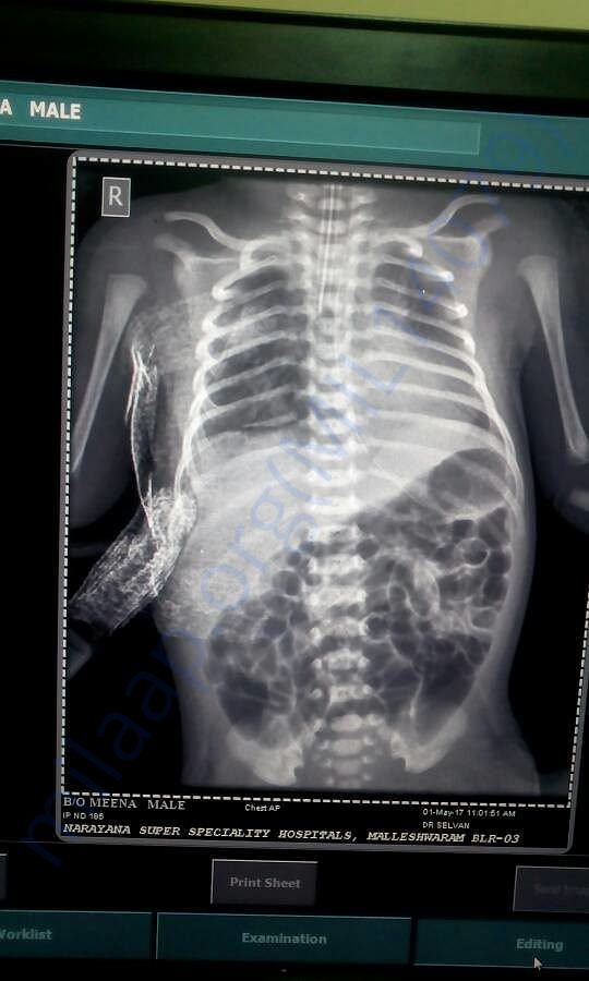 Xray Of B/O Priti showing perforation