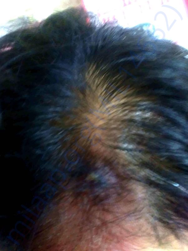 Forehead-Damage