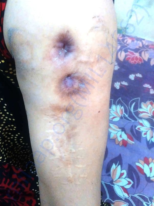 Left arm - damage