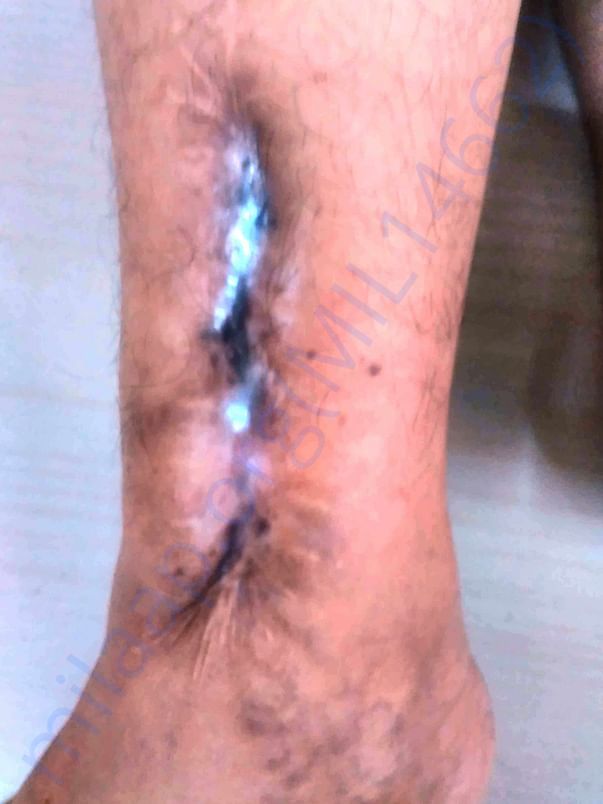 Right leg - Damage