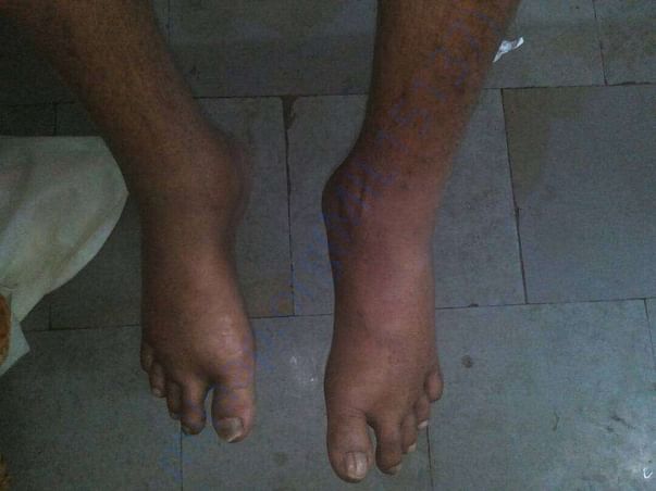 Swelled limbs because of ckd