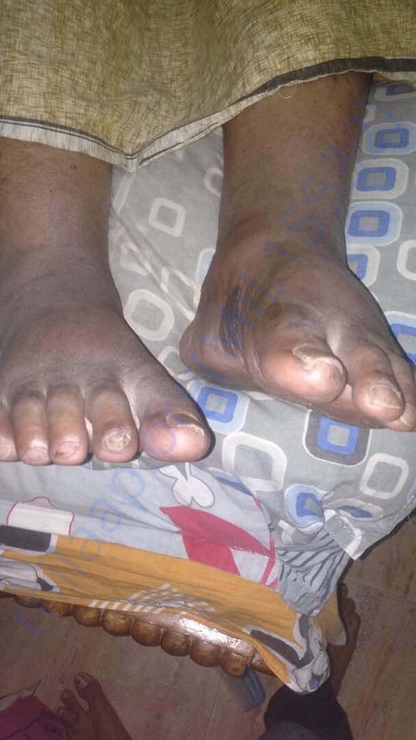 Edema formed in his legs and black scars