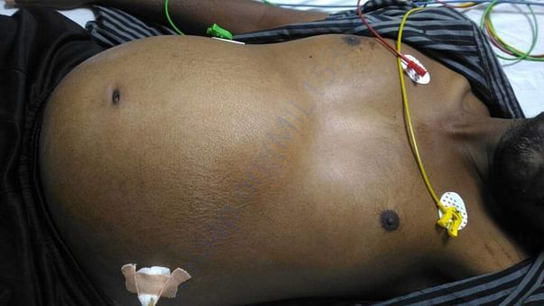 Stomach swelling due to crrihosis