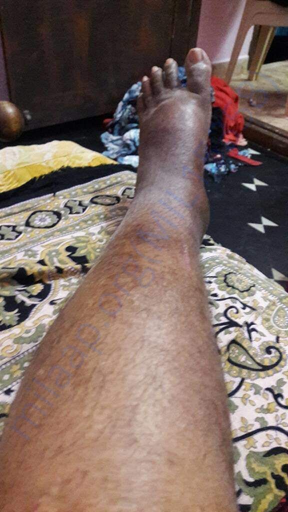 His leg
