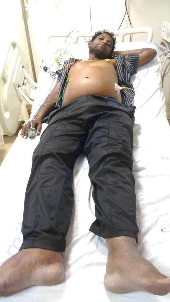 My brother admitted in icu in care hospitals