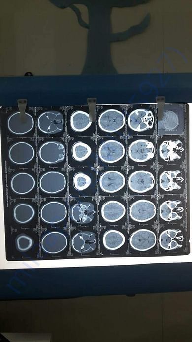 CT scan film
