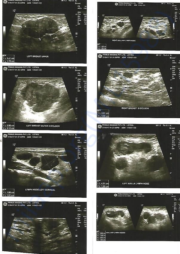 X-RAY MAMMOGRAPHY BOTH BREAST -B